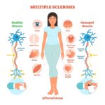 Does Ms Cause Hair Loss ?