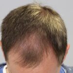 Can Creatine Cause Hair Loss ?