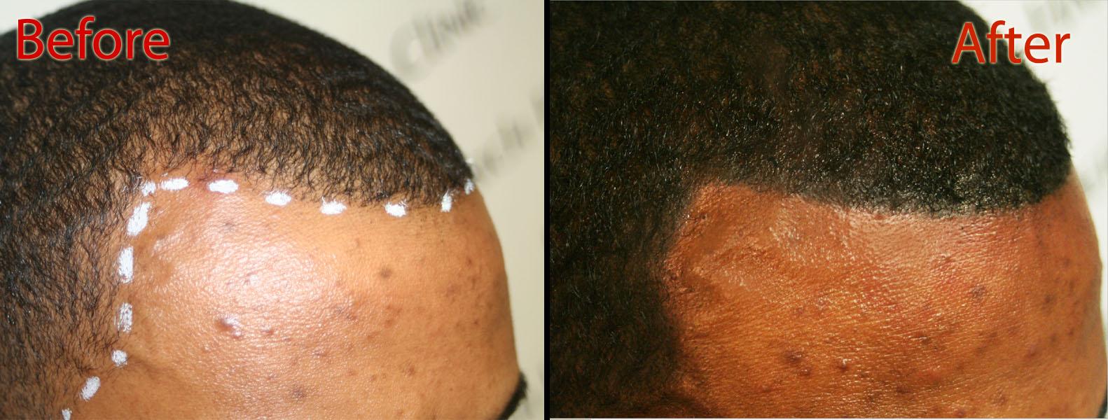 Can Creatine Cause Hair Loss ? Can Creatine Cause Hair Loss ? Can Creatine Cause Hair Loss ? Can Creatine Cause Hair Loss ?