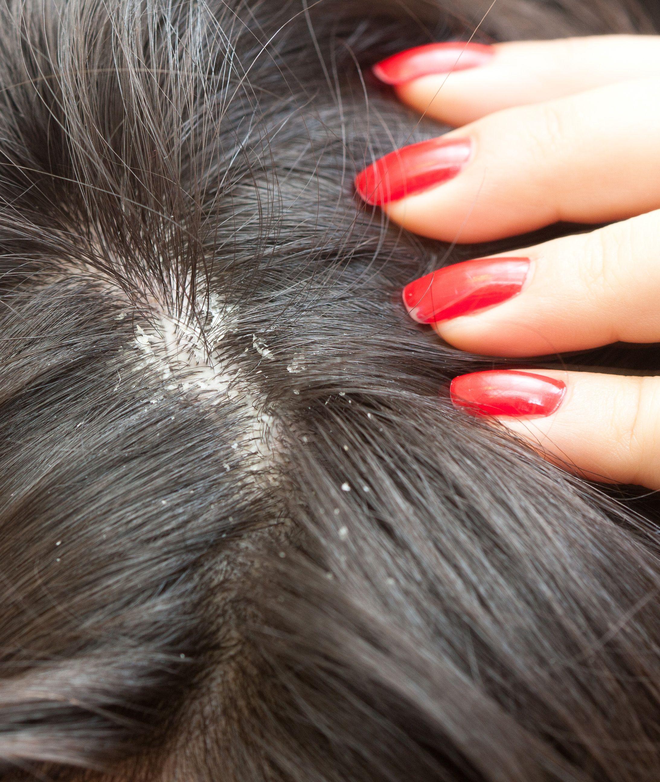 Can Dandruff Cause Hair Loss ? Can Dandruff Cause Hair Loss ? Can Dandruff Cause Hair Loss ? Can Dandruff Cause Hair Loss ?