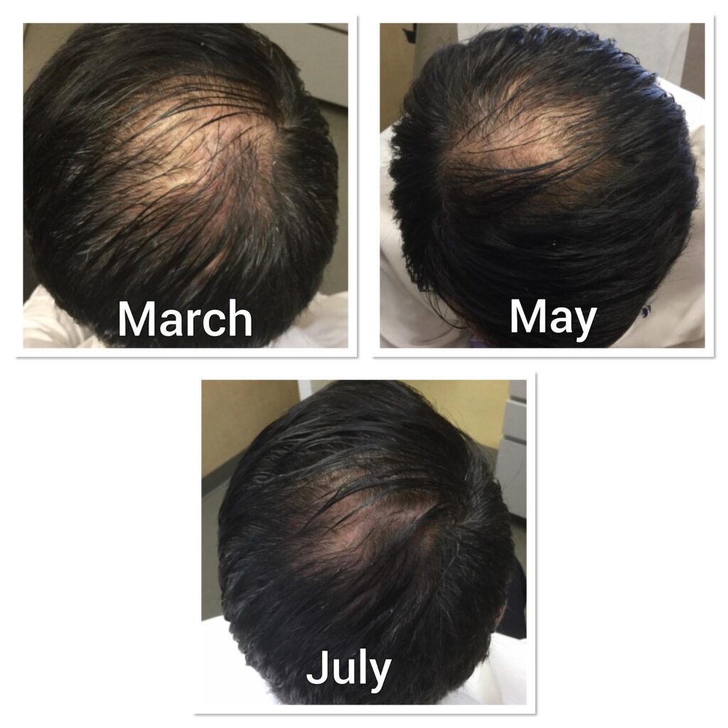 How Much Does Prp For Hair Loss Cost ?