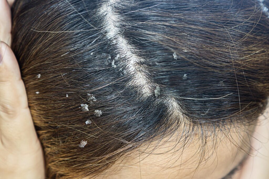 Can Dandruff Cause Hair Loss ?