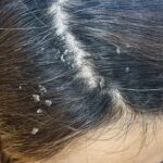 Can Dandruff Cause Hair Loss ?