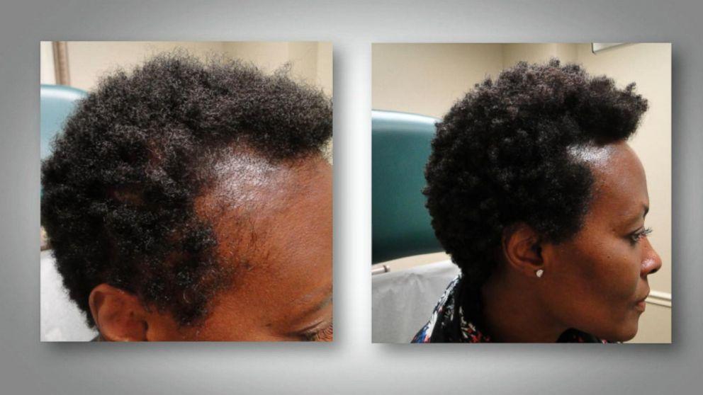 How To Get A Job In Hair Loss Research ?