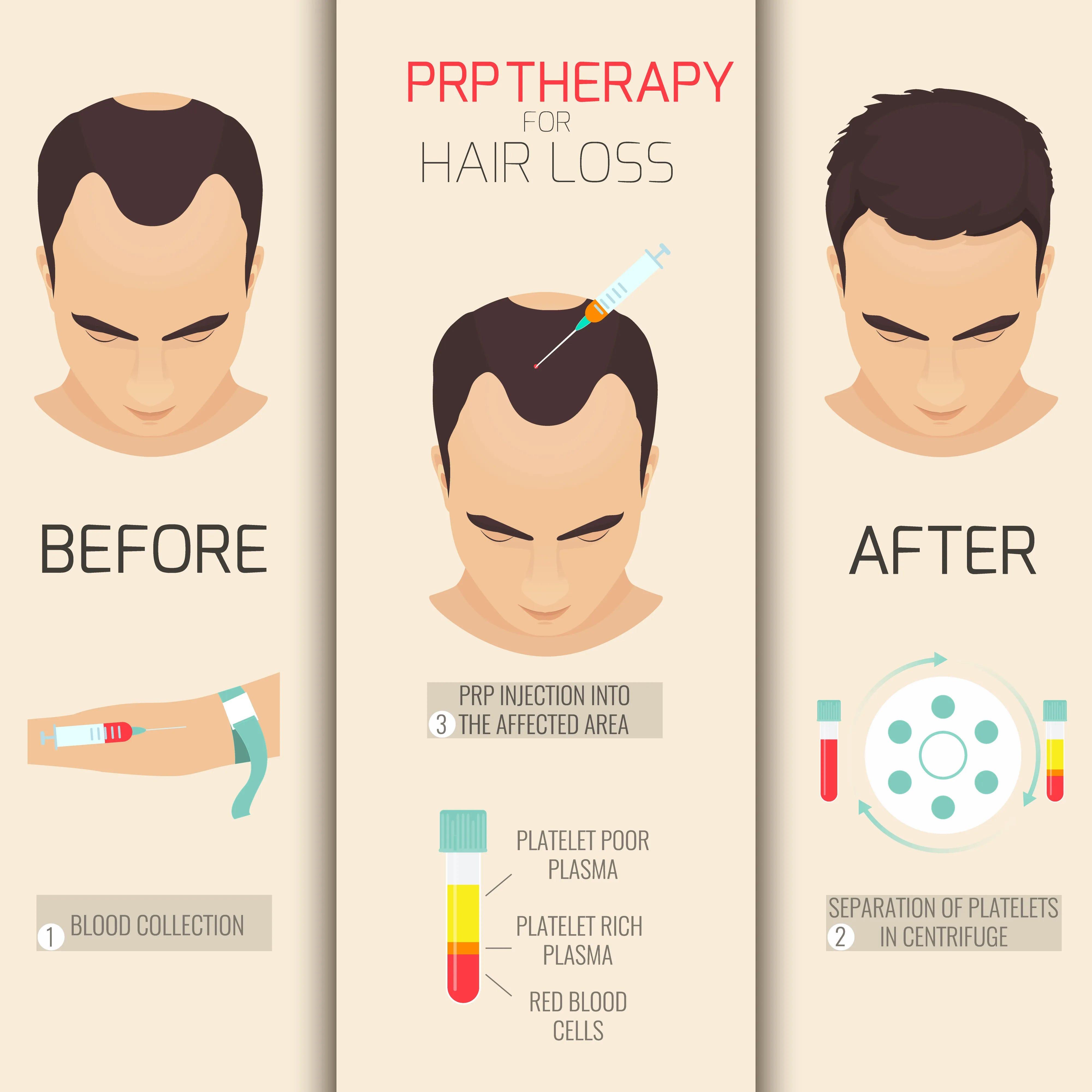 How Much Does Prp For Hair Loss Cost ? How Much Does Prp For Hair Loss Cost ? How Much Does Prp For Hair Loss Cost ? How Much Does Prp For Hair Loss Cost ?
