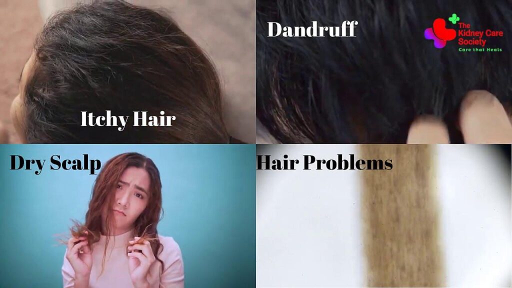 Does Dialysis Cause Hair Loss ?