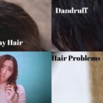 Does Dialysis Cause Hair Loss ?