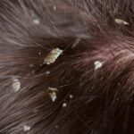 Will Lice Cause Hair Loss ?