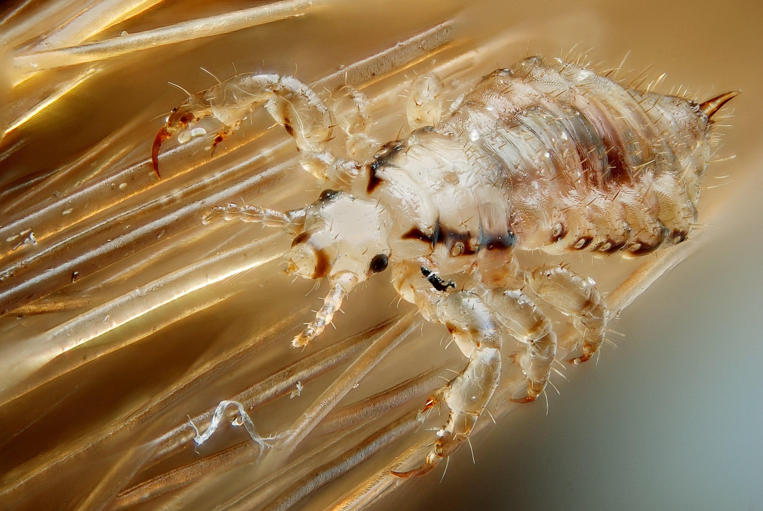 Will Lice Cause Hair Loss ? Will Lice Cause Hair Loss ? Will Lice Cause Hair Loss ? Will Lice Cause Hair Loss ?