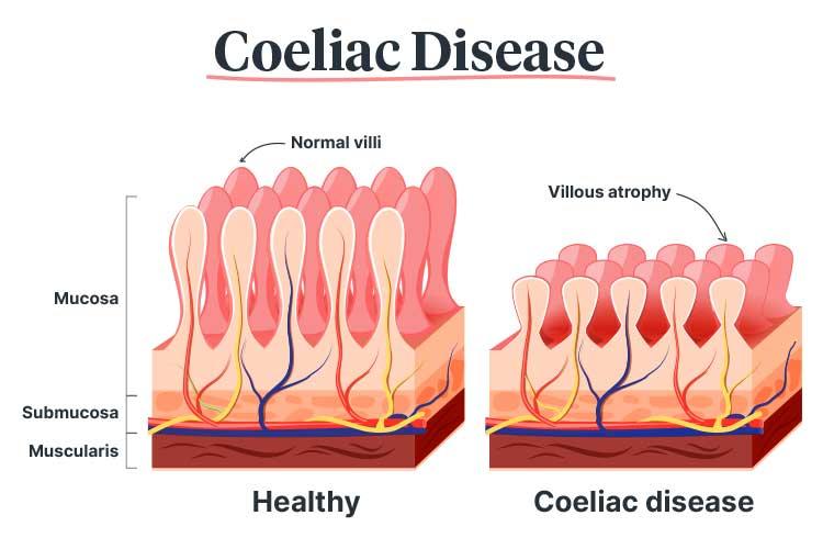 Does Coeliac Disease Cause Hair Loss ?