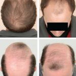 Will Hair Loss From Steroids Grow Back ?