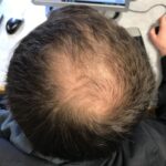 Is Hair Loss A Sign Of Diabetes ?