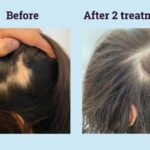 What Are The Worst Steroids For Hair Loss ?