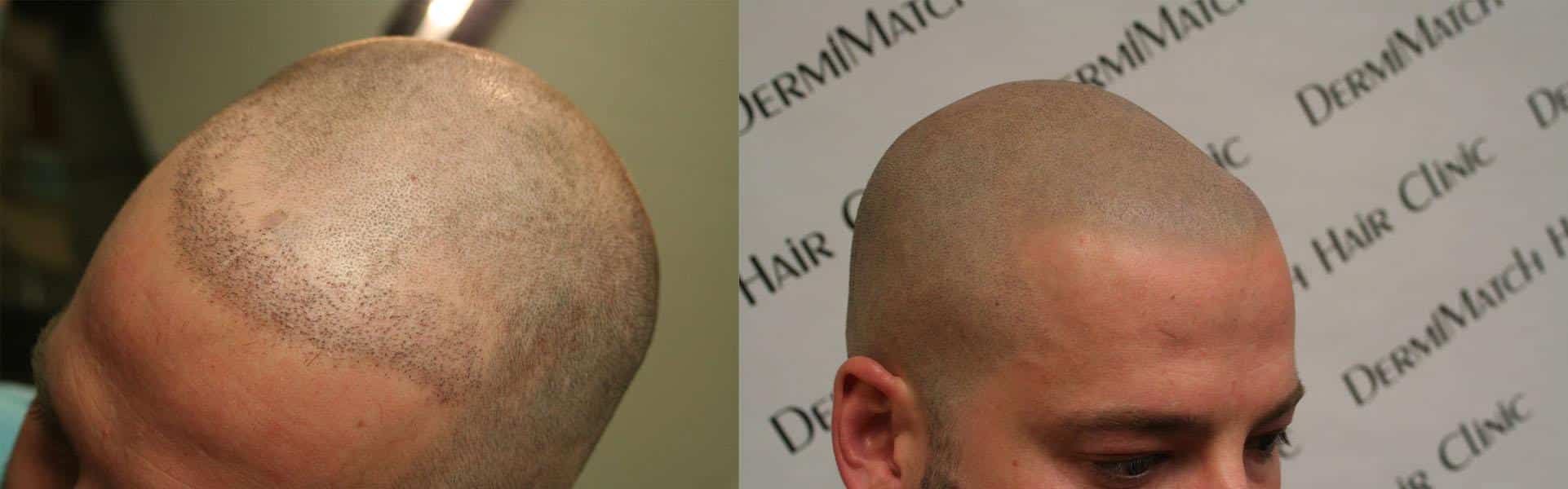 Which Statin Does Not Cause Hair Loss ? Which Statin Does Not Cause Hair Loss ?