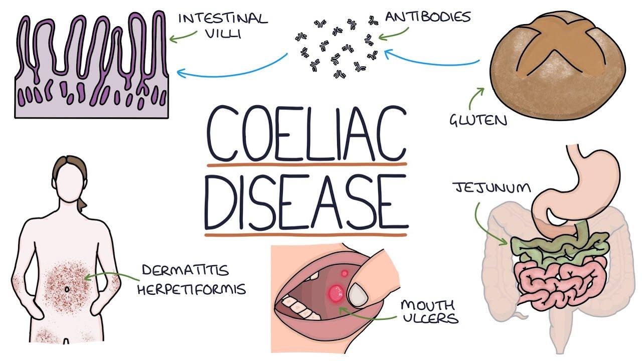 Does Coeliac Disease Cause Hair Loss ? Does Coeliac Disease Cause Hair Loss ? Does Coeliac Disease Cause Hair Loss ? Does Coeliac Disease Cause Hair Loss ?