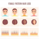 How To Stop Hair Loss Due To Weight Loss ?