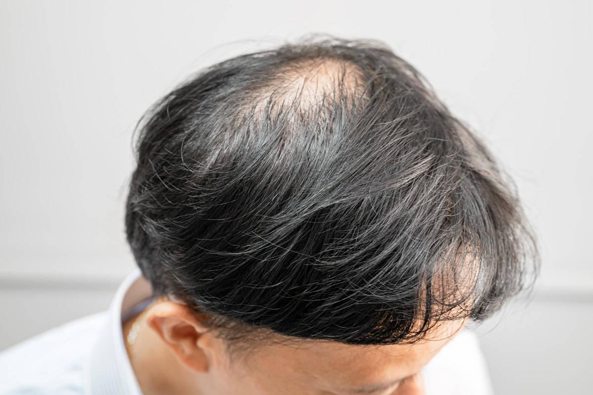 How To Stop Hair Loss Due To Weight Loss ? How To Stop Hair Loss Due To Weight Loss ? How To Stop Hair Loss Due To Weight Loss ? How To Stop Hair Loss Due To Weight Loss ?