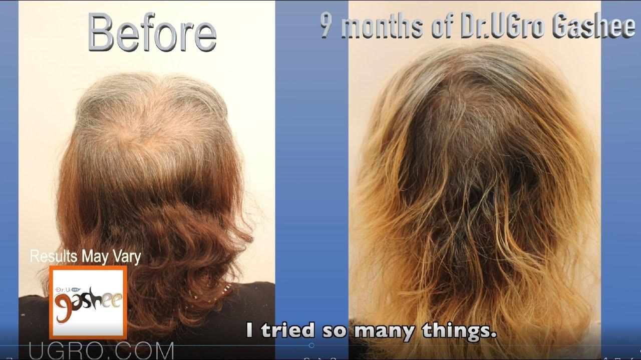 What Is A Good Iodine For To Reverse Hair Loss ? What Is A Good Iodine For To Reverse Hair Loss ? What Is A Good Iodine For To Reverse Hair Loss ? What Is A Good Iodine For To Reverse Hair Loss ?