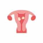 Can Fibroids Cause Hair Loss ?