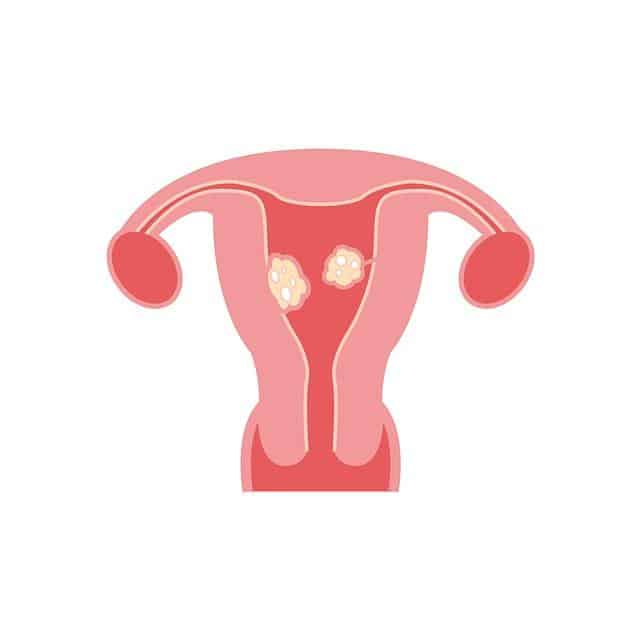 Can Fibroids Cause Hair Loss ?