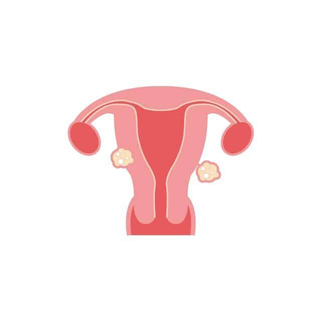 Can Fibroids Cause Hair Loss ? Can Fibroids Cause Hair Loss ?